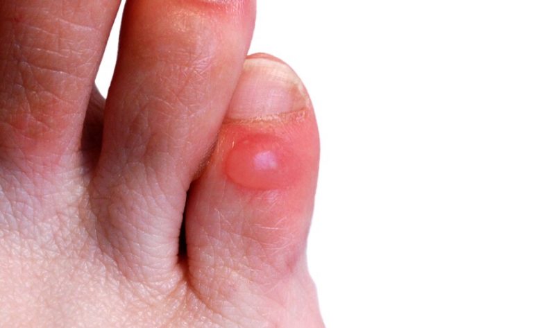 How To Pop a Blister