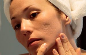 14 Ways To Treat Acne Scars